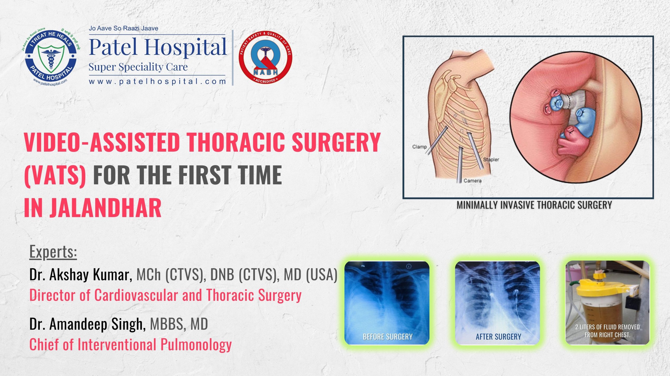 Scarless Lung Surgery for the first time in Jalandhar, Punjab