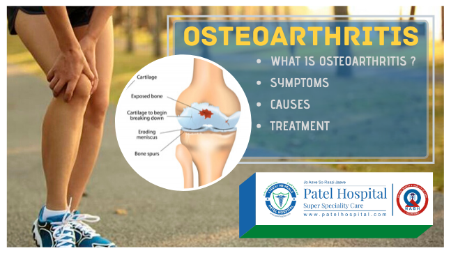 MANAGEMENT OF OSTEOARTHRITIS – Symptoms, causes, prevention & treatments