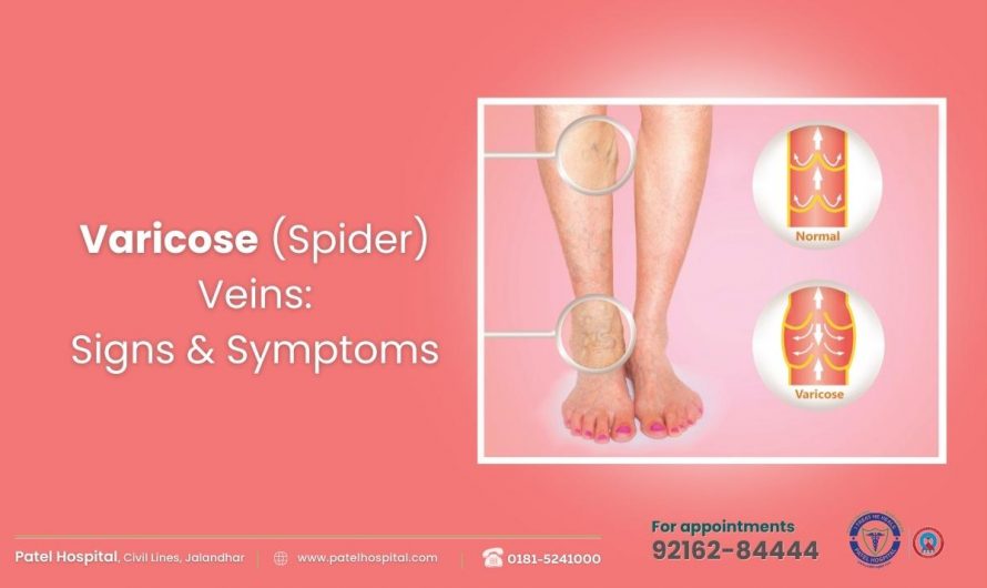 Varicose (Spider) Veins: Signs & Symptoms