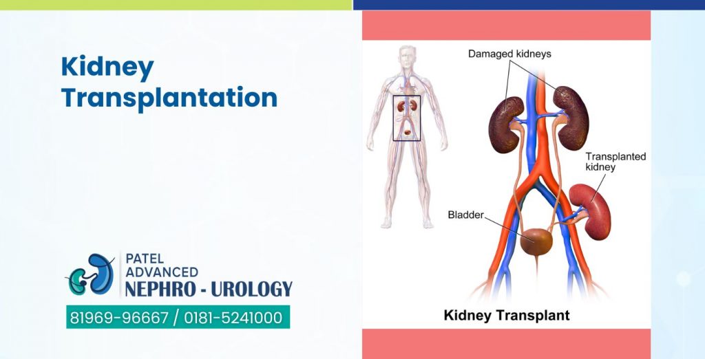 Kidney Transplantation Best Kidney Transplant Hospital in Jalandhar, Punjab Best Cancer