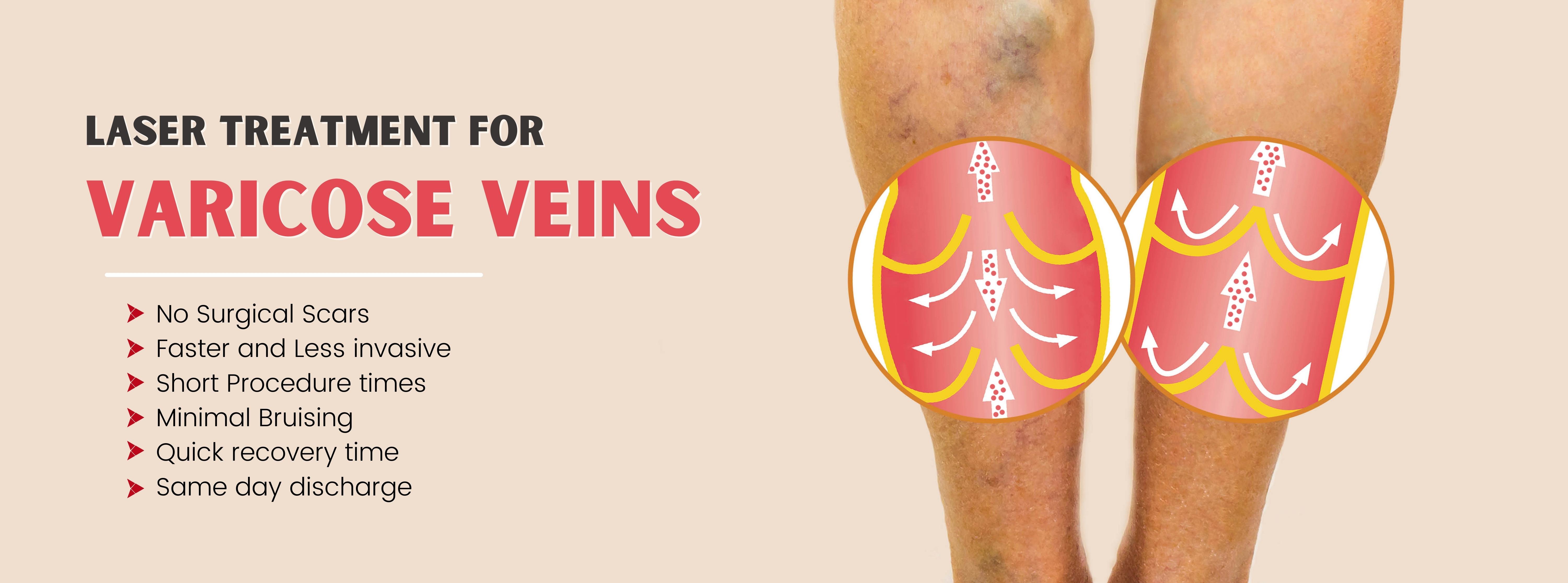 Varicose Veins Laser Treatment Cost In India